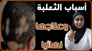 اسباب الثعلبة وعلاجها نهائيا