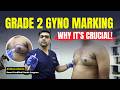 Grade 2 Gynecomastia Surgery India | जानिए Marking & Liposuction Use | Dr DC, Plastic Surgeon Pune