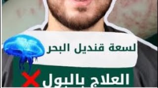 لسعة قنديل البحر  العلاجبالبول‼️⛔️