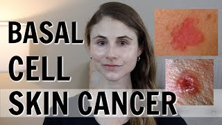 BASAL CELL SKIN CANCER: WHAT YOU SHOULD KNOW| DR DRAY