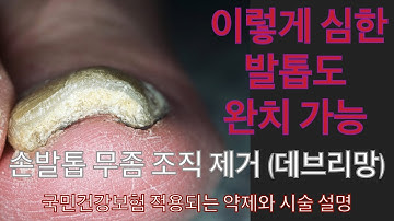 손발톱 무좀 완치 - 두꺼워진 부분을 없애고, 그 다음에 항진균제 물약을 바르고 알약을 먹기