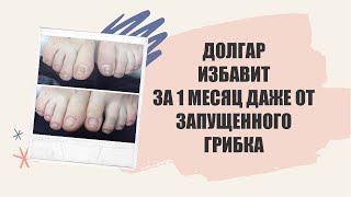 Грибок на большом пальце ноги отзывы