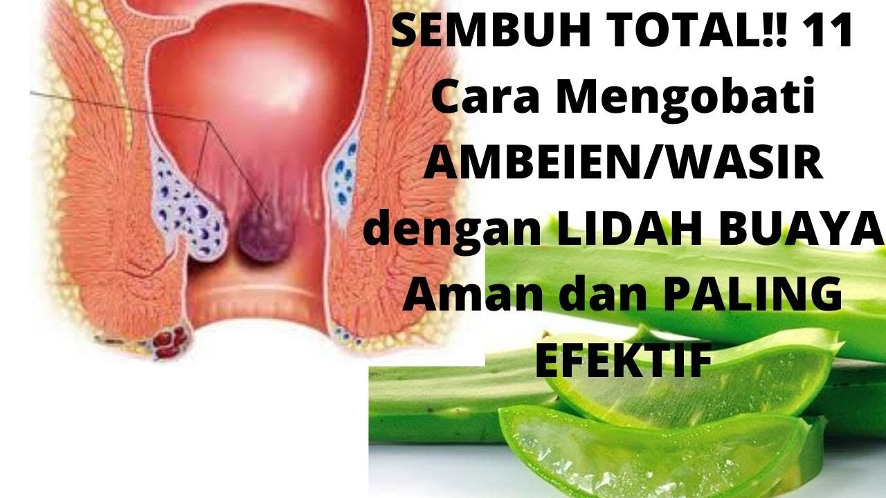 SEMBUH TOTAL!! 11 Cara Mengobati AMBEIEN/WASIR dengan LIDAH BUAYA Aman