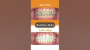 Hành trình LỘT XÁC nhờ niềng răng của Mỹ Hiền