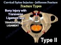 Cervical Spine Injuries Jefferson Fracture - Everything You Need To Know - Dr. Nabil Ebraheim