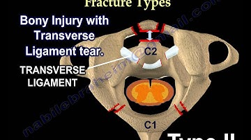 Cervical Spine Injuries Jefferson Fracture - Everything You Need To Know - Dr. Nabil Ebraheim