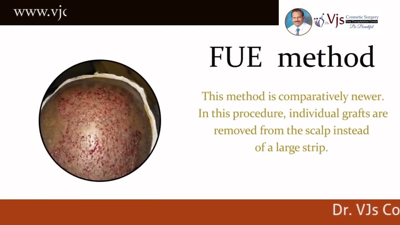Restore Your Hair Naturally with Modern Techniques | Best Hair Transplant In Vizag |  VJ’s Clinic