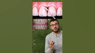 حل مشكلة فراغ بين الاسنان الامامية 