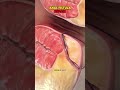 How Anal Fistula Is Repaired? (3D Animation) #analfistula #analfistulatreatment #fistulas #analfistu