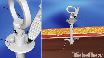 Weck EFx® Endo Fascial Closure System