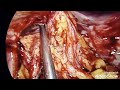 Laparoscopic Necrosectomy Abcess Drainage And Adhesiolysis In Elderly Woman From Kafin Hausa Laparoscopic Necrosectomy Abcess Drainage And Adhesiolysis In Elderly Woman From Kafin Hausa