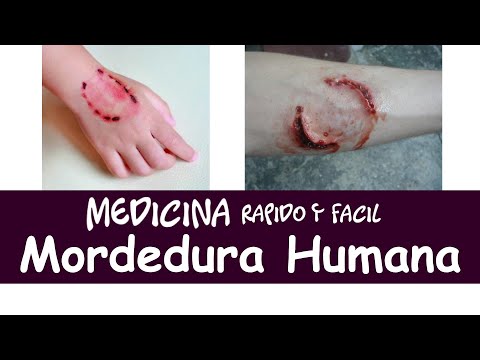 Vídeo: Mordeduras Humanas: Síntomas, Infección, Tratamientos Y Recuperación