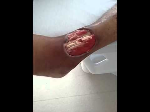 diabetic-foot-infections