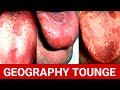 जीभ में क्या हो रहा है। How To Treat Tongue  Problem। GEOGRAPHY Tounge