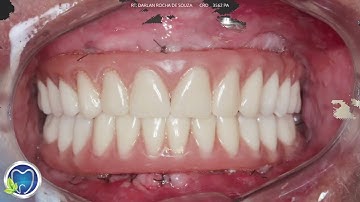 ALL ON 4 Prótese Total fixa sobre Implantes - PROTOCOLO