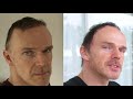 Hair transplant before and after