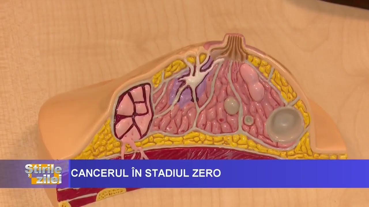 Cancerul de sân în stadiul zero: Detectarea precoce salvează vieți❗