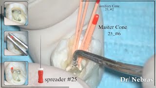 Root Canal Obturation ( Lateral Compaction technique)