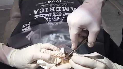 Pilar Cyst Removal || Matt Kelleher, MD