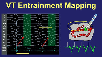 VT Entrainment Mapping of Scar/Reentry VT