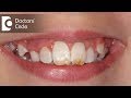 How do you treat Dental Fluorosis? - Dr. Aniruddha KB