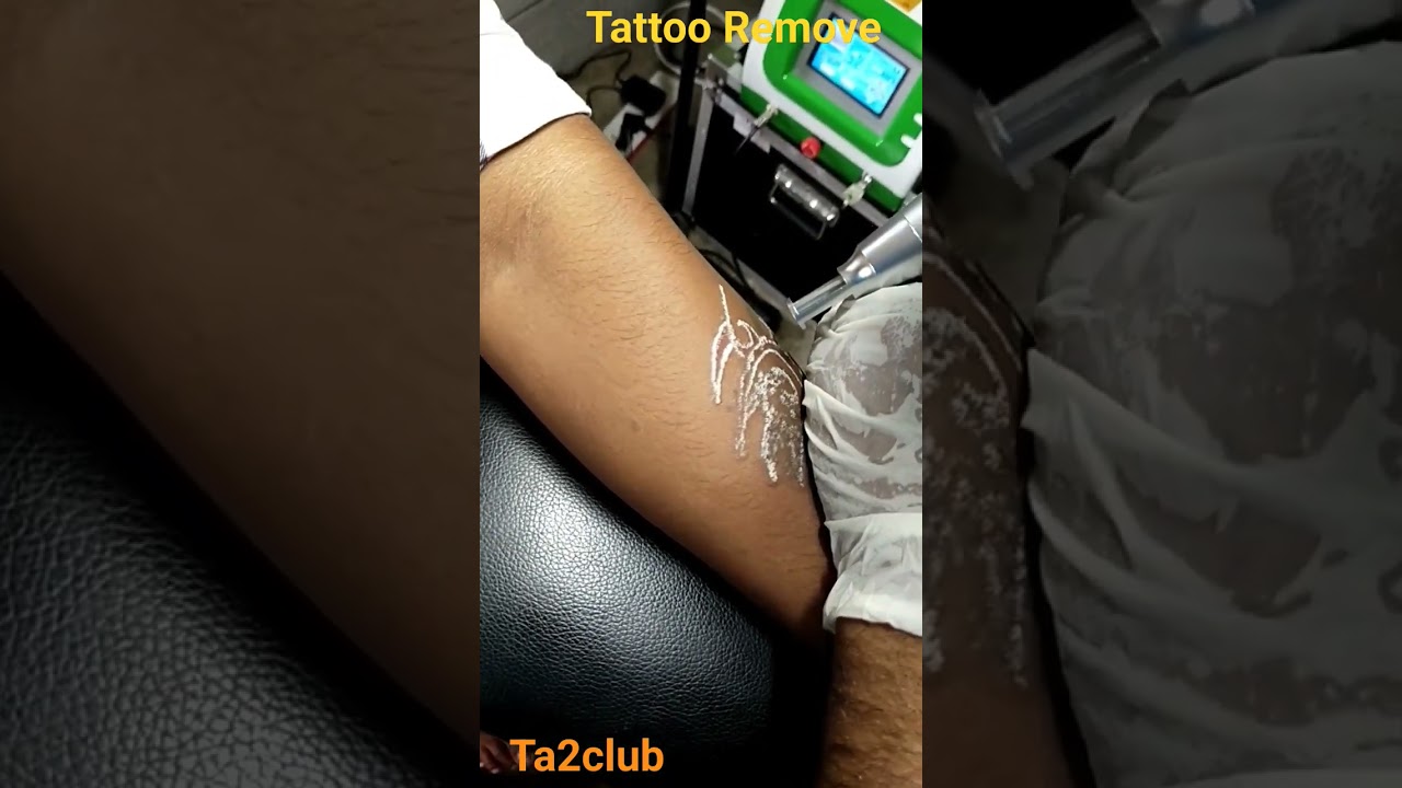 Are you need a job in defence?remove tattoo now.laser tattoo removal. 
