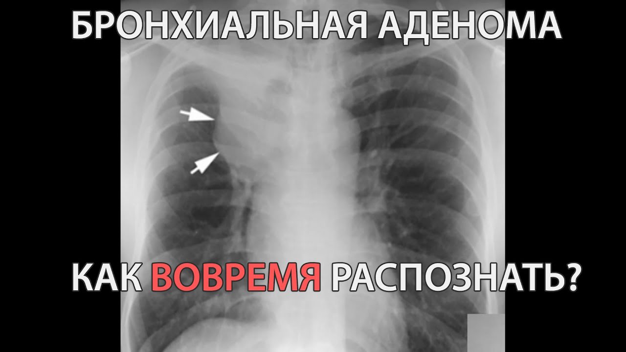 Бронхиальная аденома (подкаст)