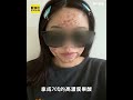 高雄果酸換膚毀容揭案外案 揪經銷商全台賣過期仿冒品 #shorts