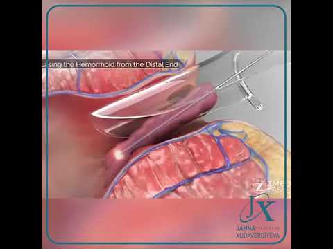 Video: Xarici hemoroid yox olacaqmi?