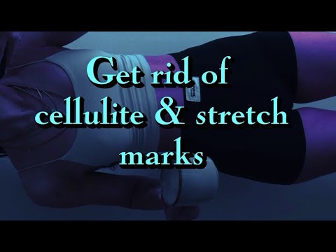 Get Rid Of Cellulite Stretch Marks 