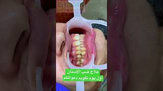 علاج ضب الاسنان
