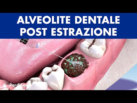 Video: 4 modi per prevenire l'incavo secco dopo l'estrazione di un dente