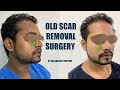  treatments for old scars   dr adarsh tripathi