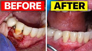 I SAVED A Tooth From DISSOLVING With A Filling, Gum Surgery, & Root Canal - External Resorption
