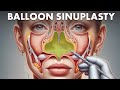 How Balloon Sinuplasty is Performed? 3D Animation (Urdu/Hindi)