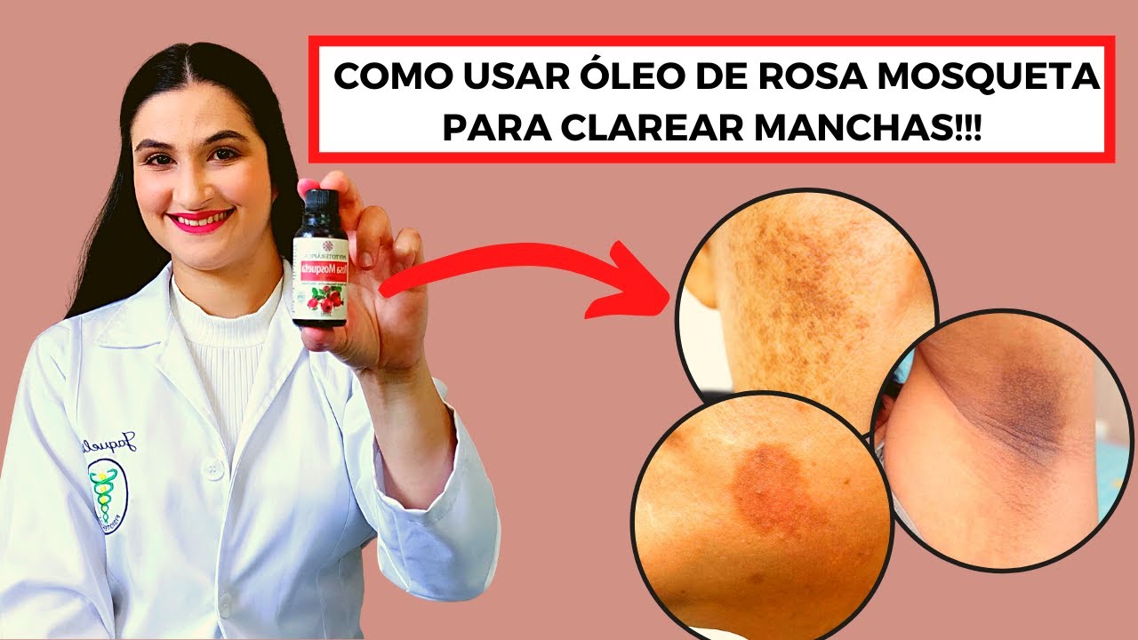 Como usar o óleo de Rosa Mosqueta para clarear manchas!