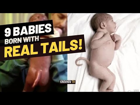 9 Babies Reported with Real Tails - Science Behind the Occurrence of Human Tails