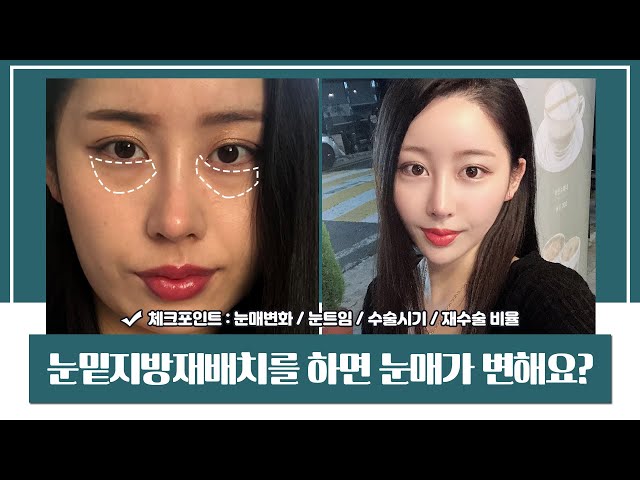눈밑지방재배치를 하면 눈매가 변해? l 압구정성형외과 l 눈밑지방없애는법 l 눈밑지방재배치수술나이 l 눈밑지방재배치재수술
