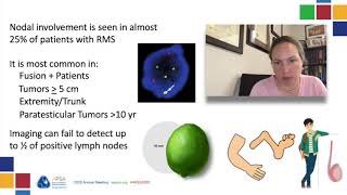 RMS: Extremity rhabdomyosarcoma- APSA 2020