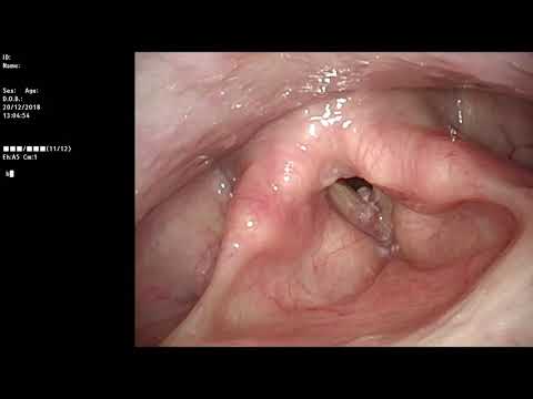 Vídeo: Pólipo Hiperplásico En Colon O Estómago: Seguimiento Y Tratamiento