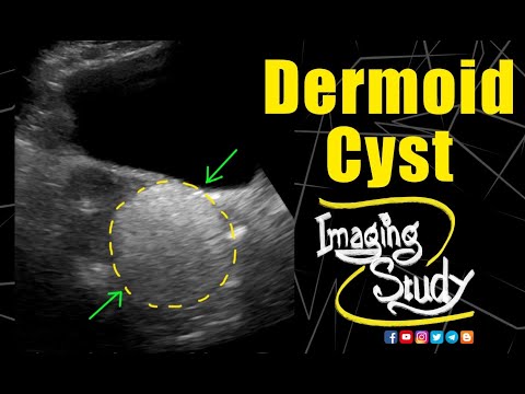 Dermoid Cyst ||
