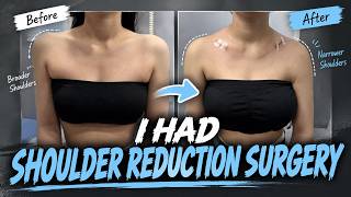 Clavicle Shortening Surgery in Korea | YBC Hospital screenshot 5