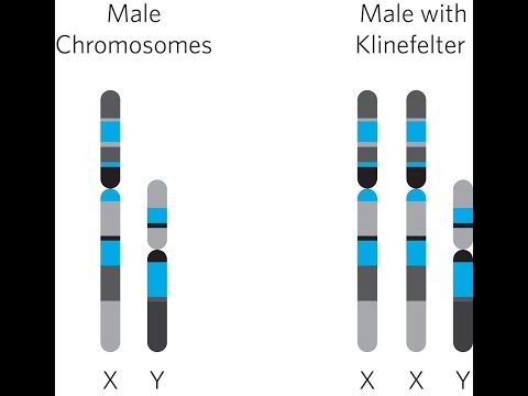 Video: Skákající Translokace Chromozomu 1q, Ke Které Dochází Vícestupňovým Procesem U Akutní Myeloidní Leukémie, Progredoval Z Myelodysplastického Syndromu S Mutací TET2