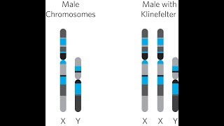 Klinefelter Syndrome