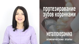 Протезирование зубов металлокерамическими коронками - клинические этапы