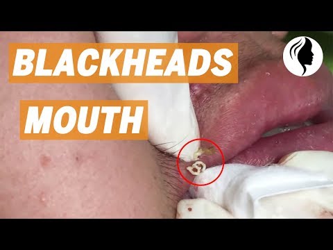 SQUEEZE BLACKHEADS AROUND THE MOUTH