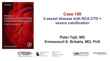 Case 150: Manual of CTO PCI - Three-vessel PCI with RCA CTO