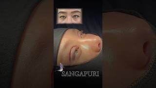Верхняя блефаропластика. Сангапури. #blefaroplastika #узбекистан #сангапури #kokand