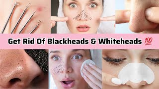 How To get Rid Of Blackheads & Whiteheads | Everyday Glow up