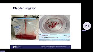 Continuous Bladder Irrigation